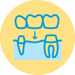 dental bridge tooth replacement