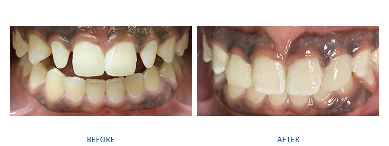before and after cosmetic dental bonding